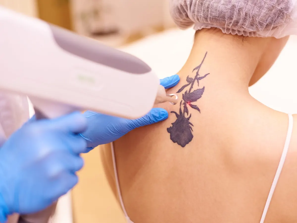 Stock photograph of a model: a gloved clinician passes a laser handpiece over a dark floral tattoo on a woman's upper back