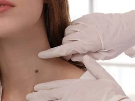 doctor examines a mole