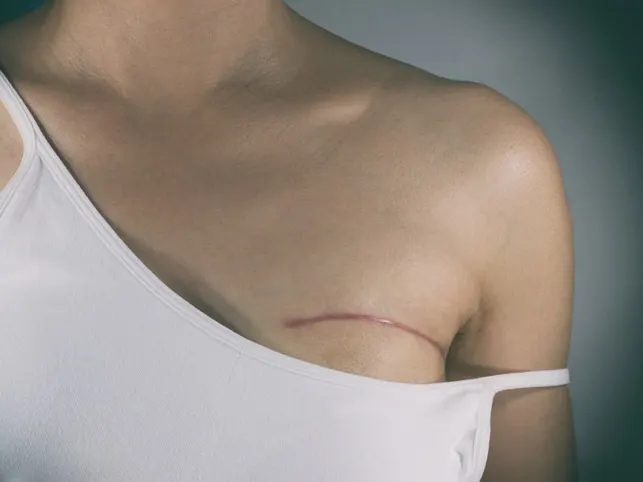 A woman's collarbone area with a thin surgical scar, in a white camisole