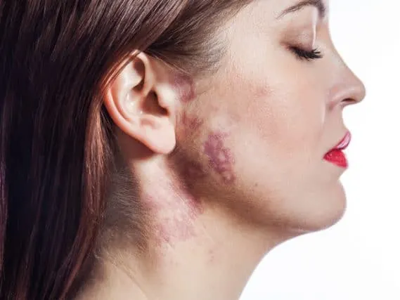 woman with port-wine stain (birthmark) on her face.