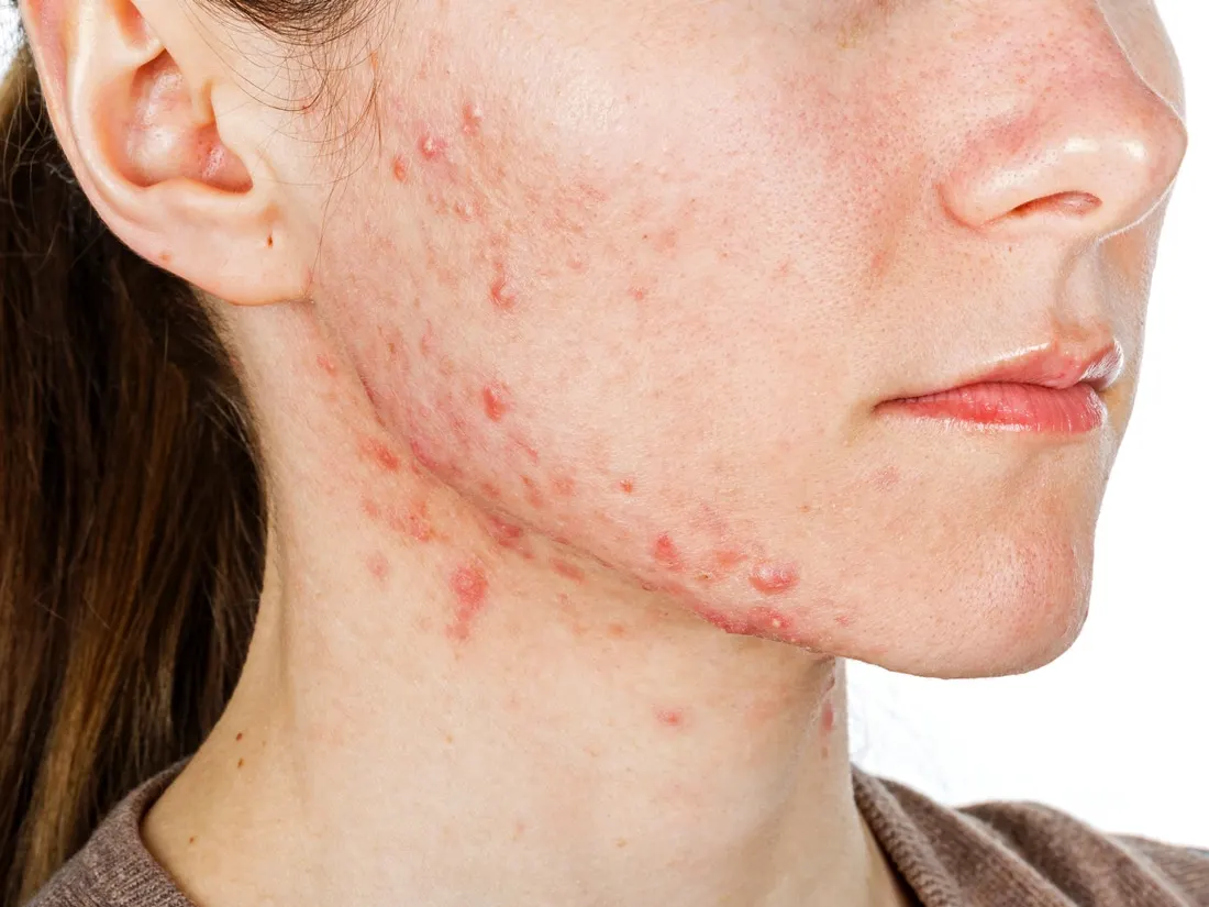 Woman with acne breakout on her chin, neck, and cheeks