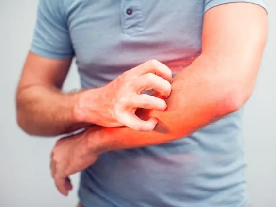 A model in a blue polo scratching a red, inflamed forearm