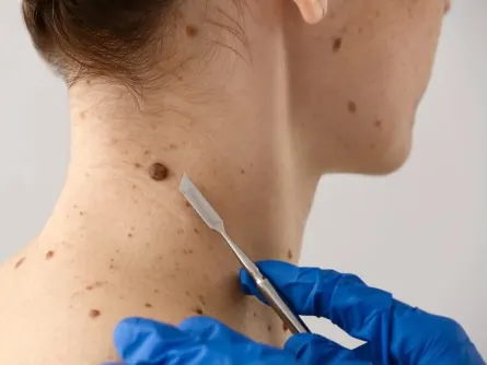 Doctor with lancet going to remove mole from patient's skin