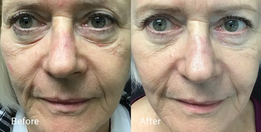 Before & after laser skin treatments Miami Beach, FL