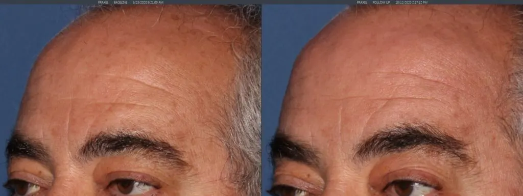 Before and after sciton laser treatment Miami Beach, FL