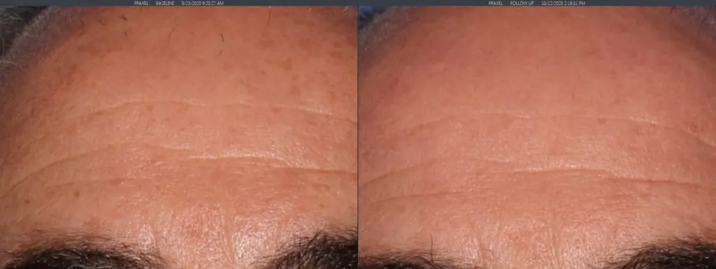 older man’s forehead before and after sciton laser treatment, much smoother and clearer skin after