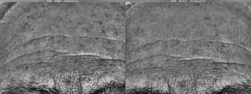 Two close-up grayscale skin images of a forehead with lines, side by side