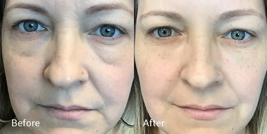 before & after photo of botox injectables to reduce frown lines