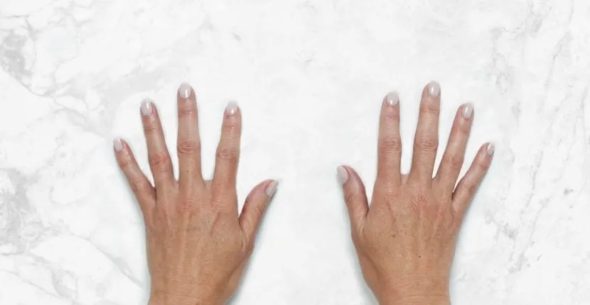 Before treatment: both hands, backs up, side by side on white marble