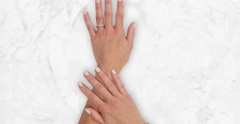After treatment: the back of one hand wearing a ring, with the other hand resting on the wrist, on white marble