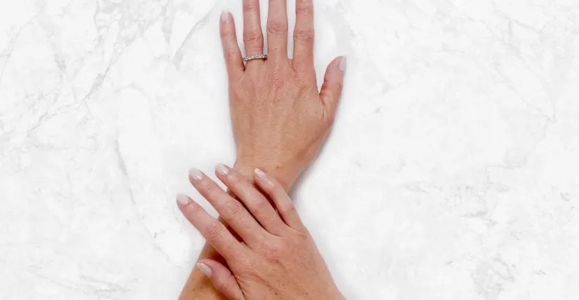 Before treatment: the back of one hand wearing a ring, with the other hand resting on the wrist, on white marble