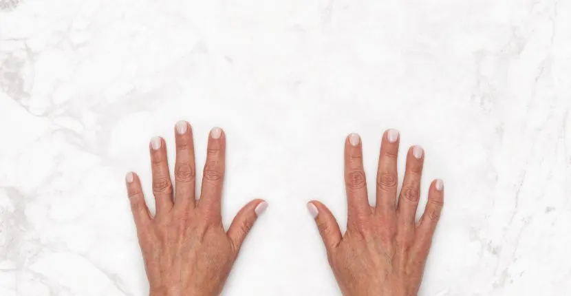 Before treatment: both hands, backs up, side by side on white marble