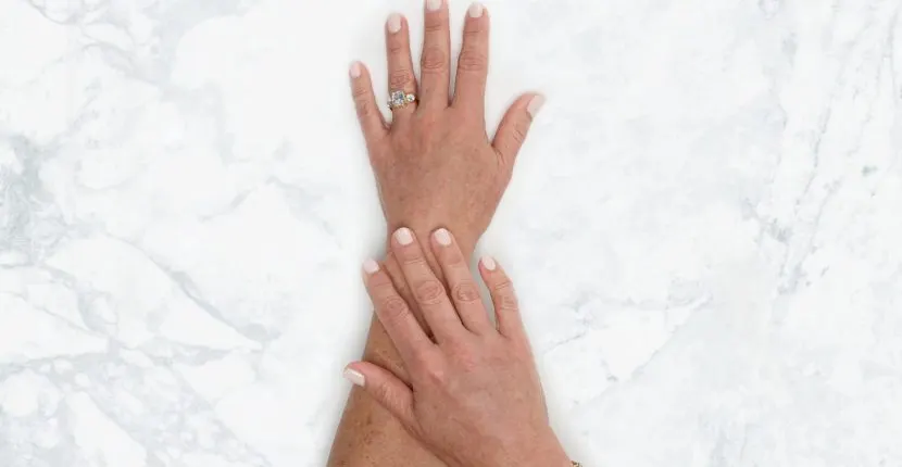 After treatment: the back of one hand wearing a ring, with the other hand resting on the wrist, on white marble