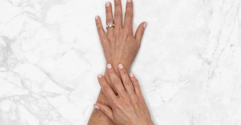 Before treatment: the back of one hand wearing a ring, with the other hand resting on the wrist, on white marble