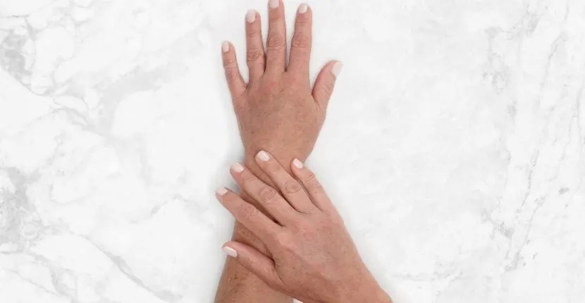 After treatment: the back of one hand with the other hand resting on the wrist, no jewelry, on white marble