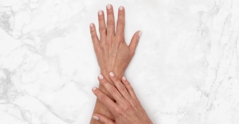 Before treatment: the back of one hand with the other hand resting on the wrist, no jewelry, on white marble