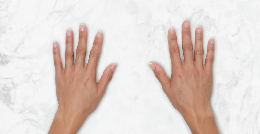 After treatment: both hands, backs up, side by side on white marble