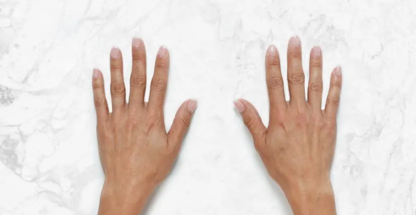 Before treatment: both hands, backs up, side by side on white marble