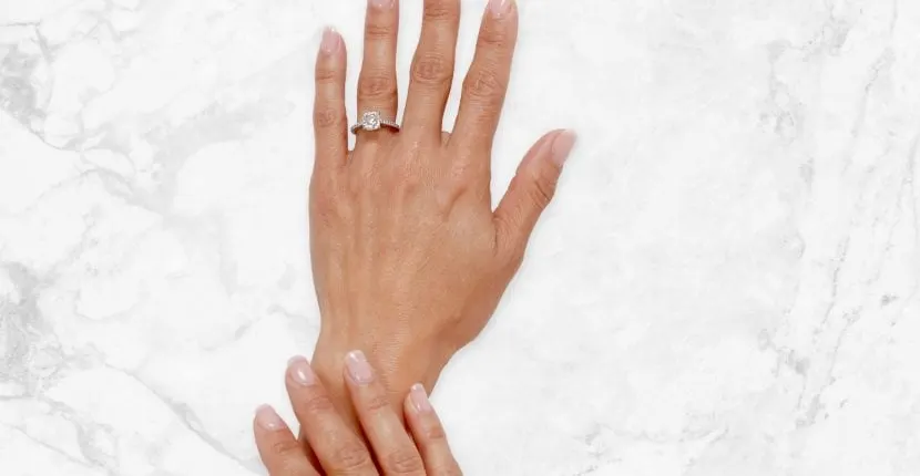Before treatment: the back of one hand wearing a ring, with the other hand resting on the wrist, on white marble