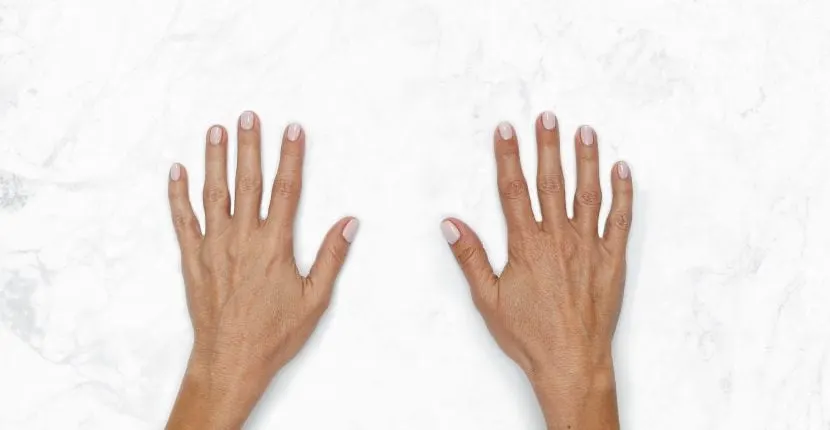 Before treatment: both hands, backs up, side by side on white marble