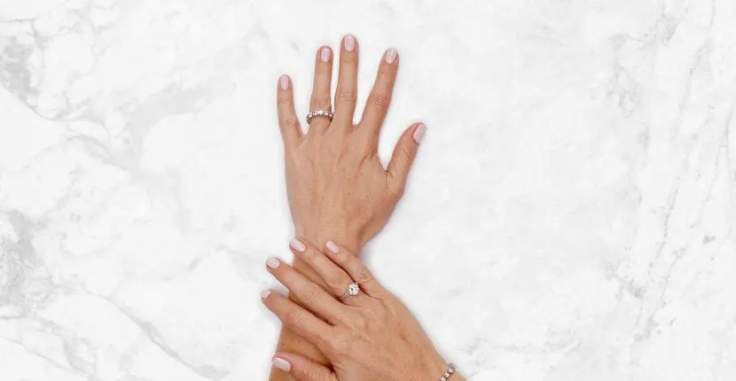 Before treatment: the back of one hand wearing a ring, with the other hand resting on the wrist, on white marble
