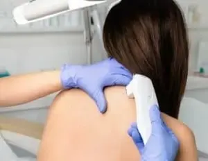 Mole removal Miami Beach, FL