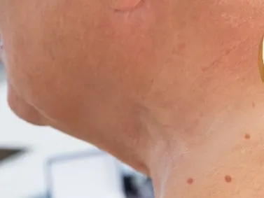 A magnifying glass held over a neck and shoulder with small red spots during a skin check