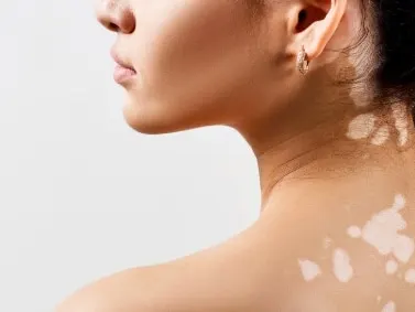 A woman seen from behind in profile with patches of lighter skin on her upper back and neck
