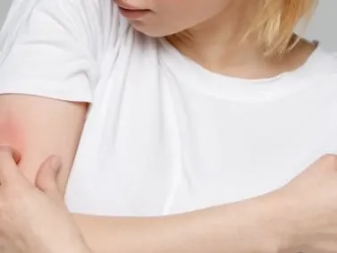 A model in a white t-shirt holding their arm with a patch of red, irritated skin