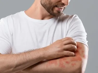 A model in a white t-shirt scratching his forearm, which looks red