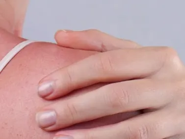 A sunburned shoulder with a hand resting on it
