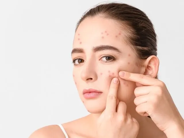 A model with several pimples on her cheek, squeezing one with her fingers