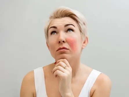 A model with short blonde hair and a red patch on her cheek, looking up thoughtfully
