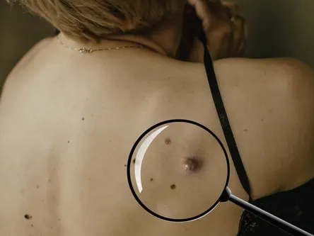 A woman's back with several moles, one seen through a magnifying glass