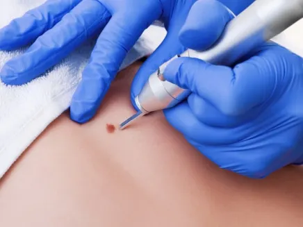 A blue-gloved hand using a small handheld device on a mole on a person's skin