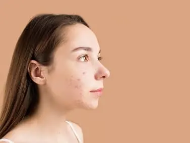 A woman's face in profile showing acne on the cheek, against a tan background