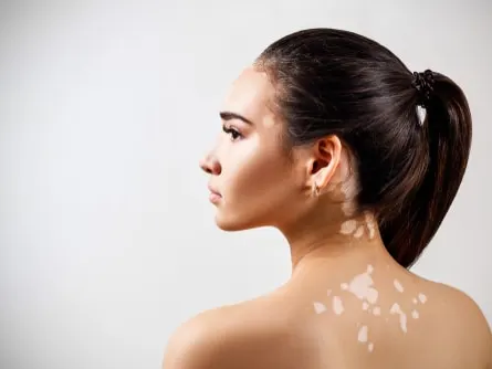 A model in profile seen from behind with lighter patches of skin on her neck and upper back