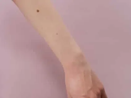 cosmetic mole removal