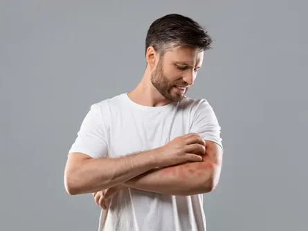 Dermatitis,,Eczema,,Allergy,,Psoriasis,Concept.,Annoyed,Middle aged,Man,In,White