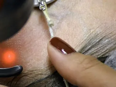 A laser handpiece with a red glow on skin near a brow