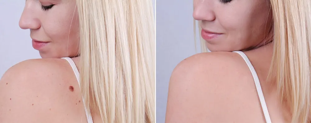 Before and after cosmetic mole removal Miami Beach, FL