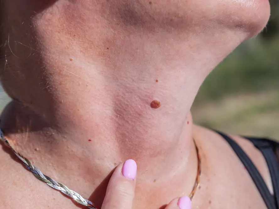 Melanoma treatment plan in Miami, FL