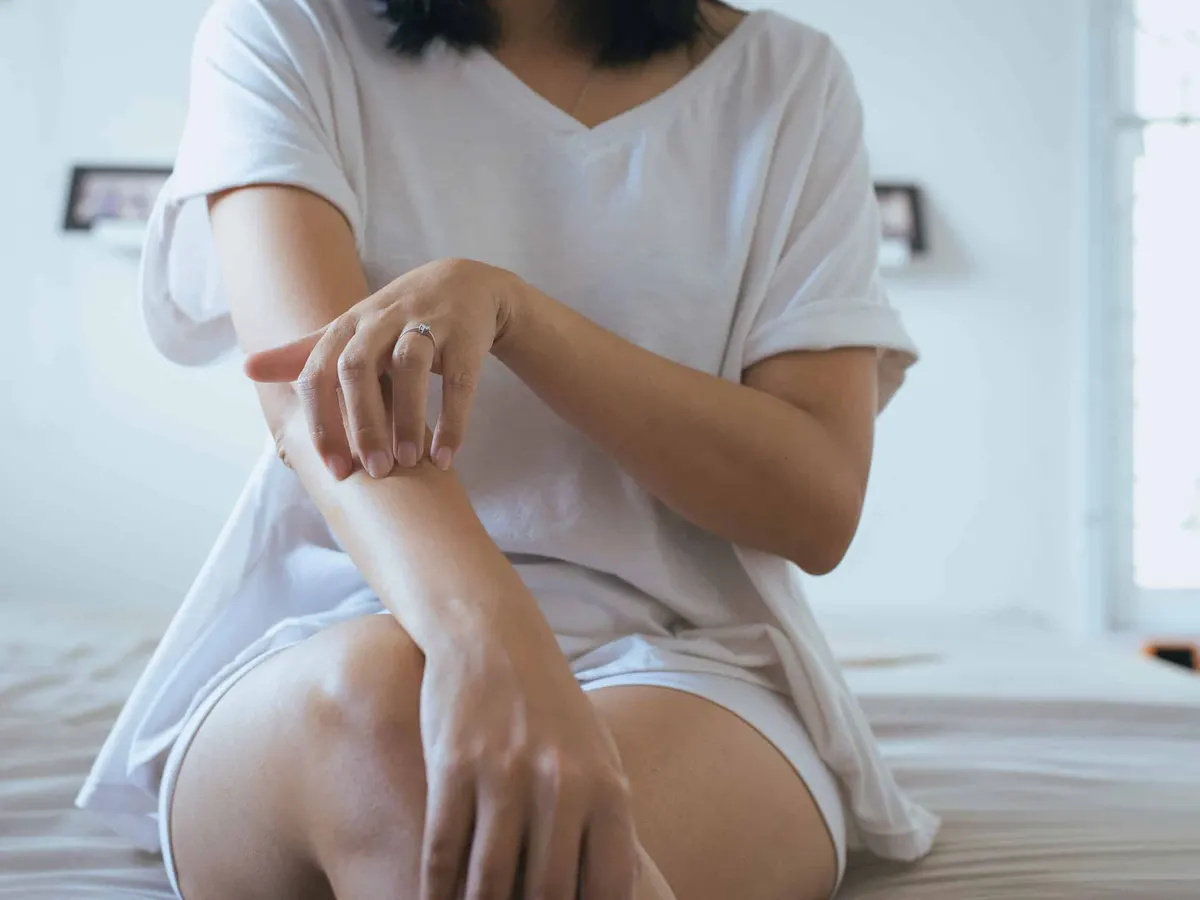 Woman experiencing psoriasis flare up in Miami, FL