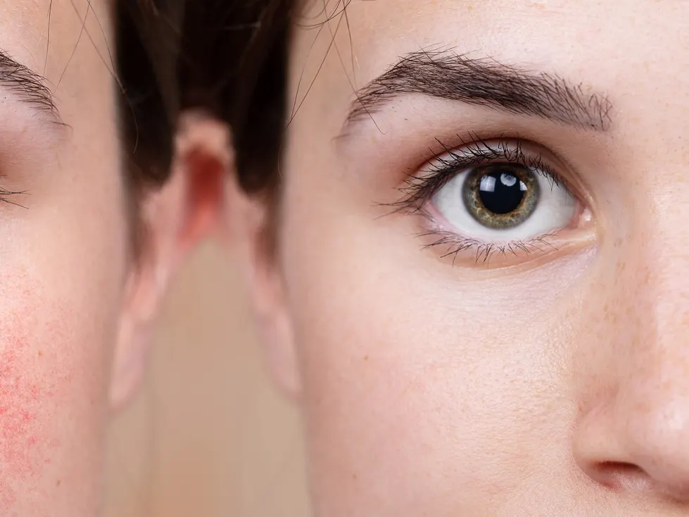 Before and after photos of a woman affected by rosacea.