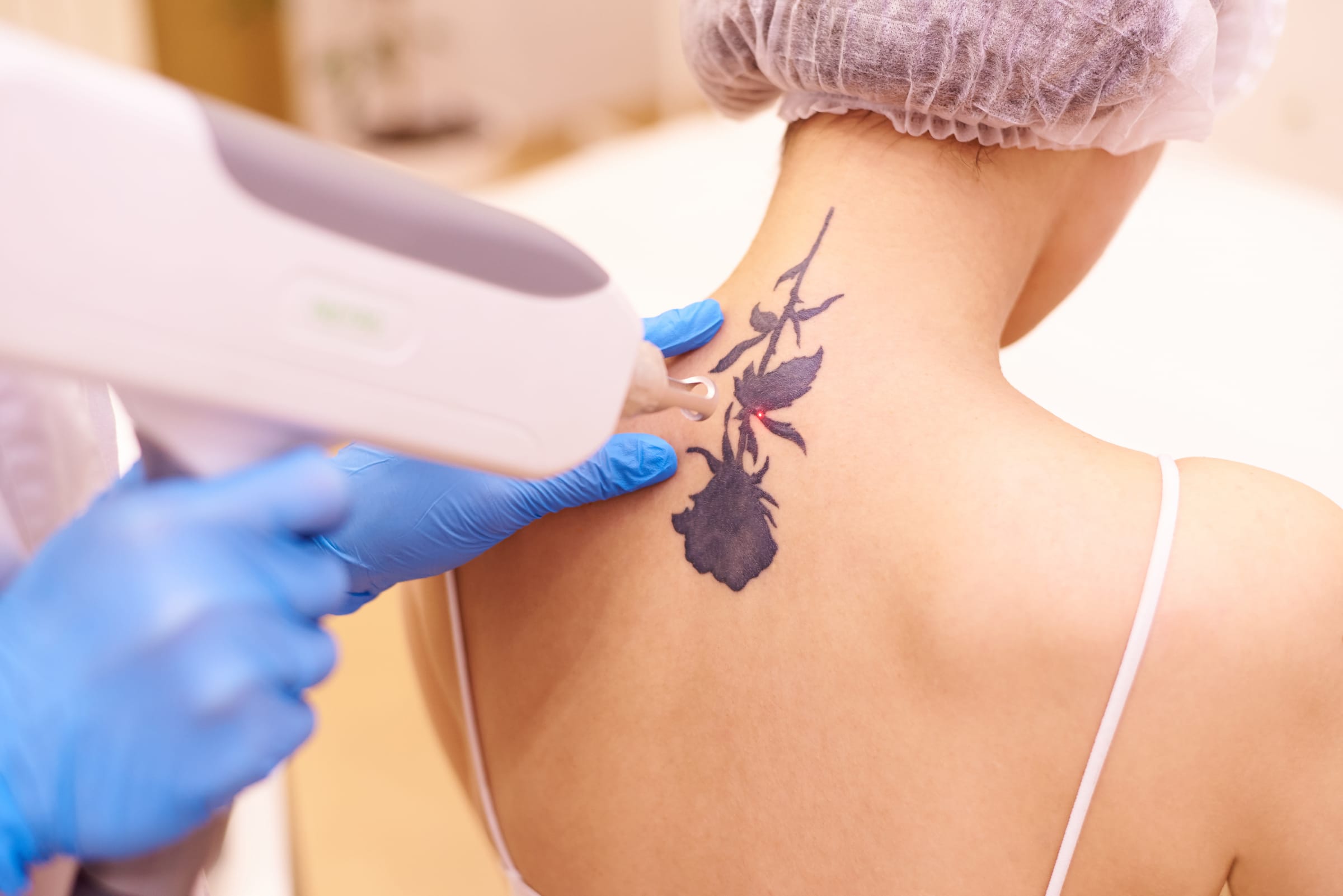 Stock photograph of a model: a gloved clinician passes a laser handpiece over a dark floral tattoo on a woman's upper back