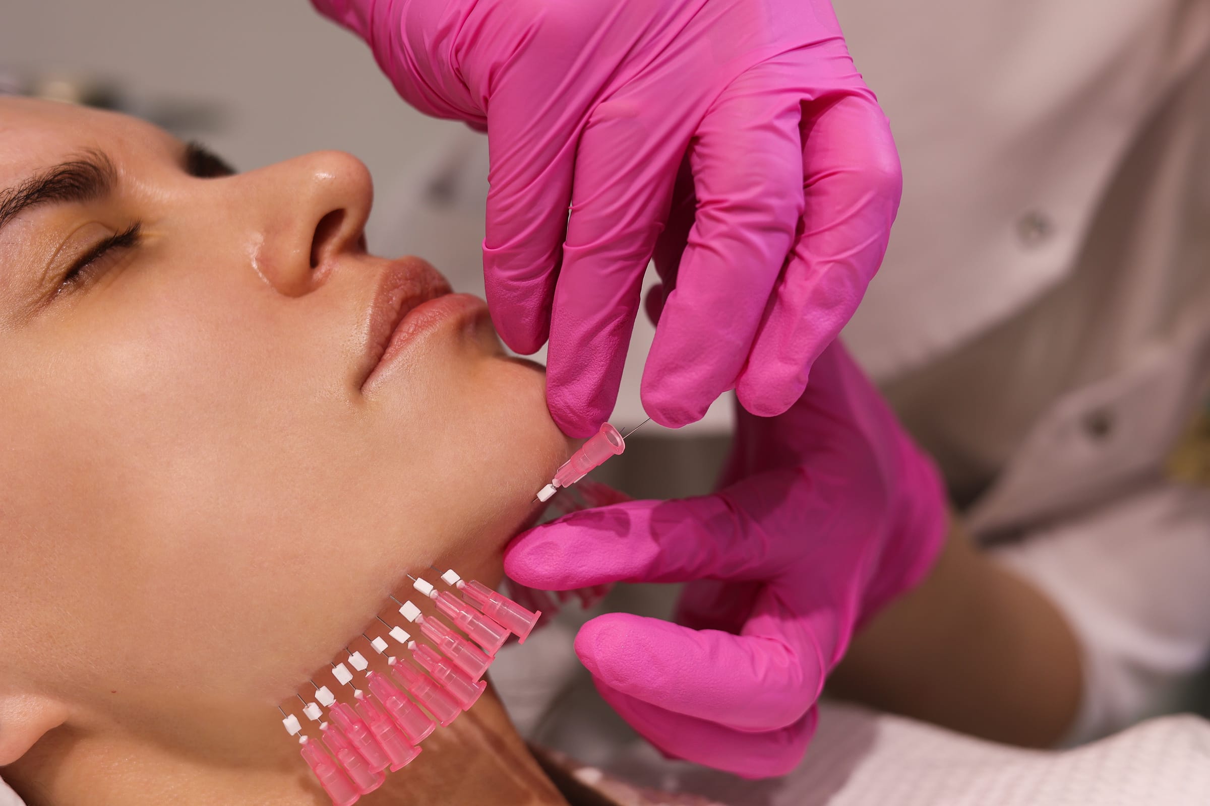 Stock photograph of a model: pink-gloved hands place a row of thread-lift needles under a woman's chin