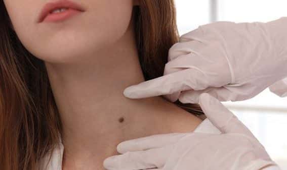 doctor examines a mole