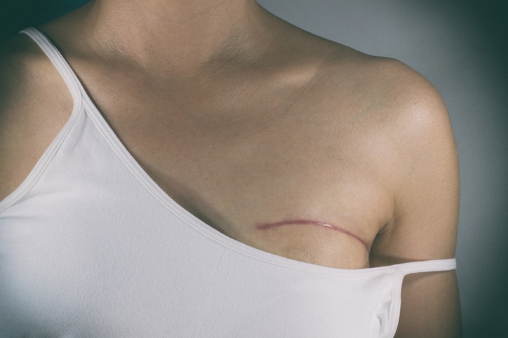 A woman's collarbone area with a thin surgical scar, in a white camisole