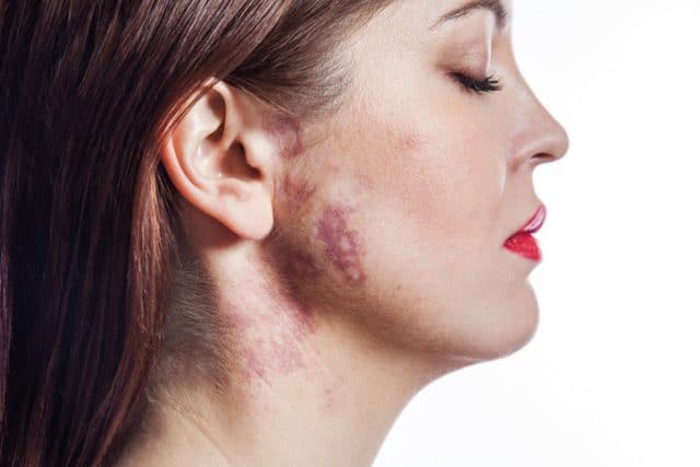 woman with port-wine stain (birthmark) on her face.