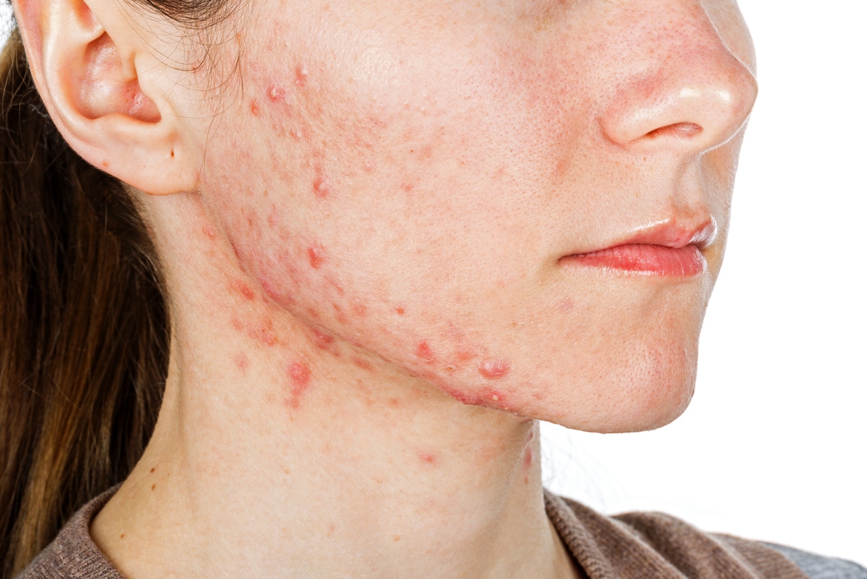 Woman with acne breakout on her chin, neck, and cheeks